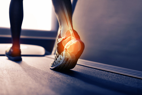 PRP Injection achilles